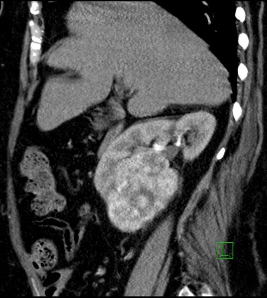 File:Clear cell renal cell carcinoma (Radiopaedia 85004-100537 D 42).jpg