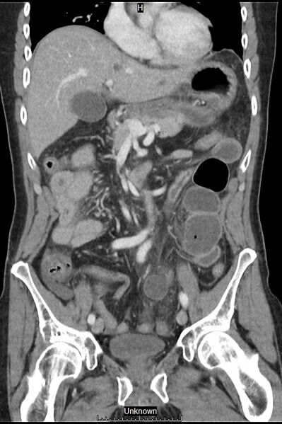 File:Closed loop bowel obstruction and ischemia (Radiopaedia 86959-103180 B 17).jpg