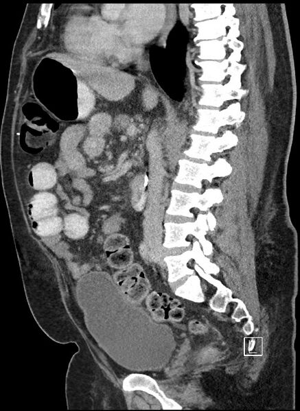 File:Closed loop obstruction - internal hernia into nephrectomy bed (Radiopaedia 59867-67320 C 50).jpg