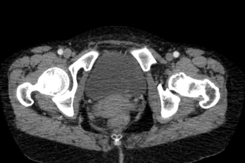 File:Closed loop small bowel obstruction (Radiopaedia 71211-81508 A 169).jpg