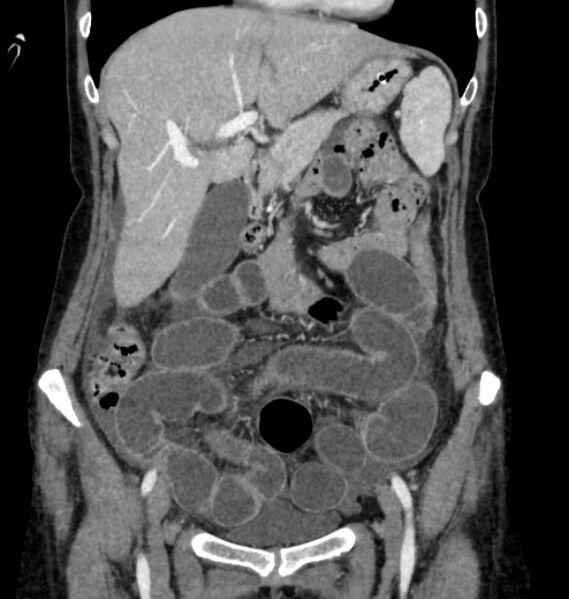 File:Closed loop small bowel obstruction (Radiopaedia 71211-81508 B 32).jpg