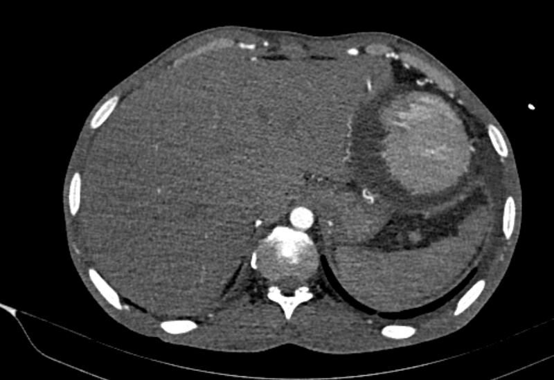 File:Coarctation of aorta with aortic valve stenosis (Radiopaedia 70463-80574 A 215).jpg