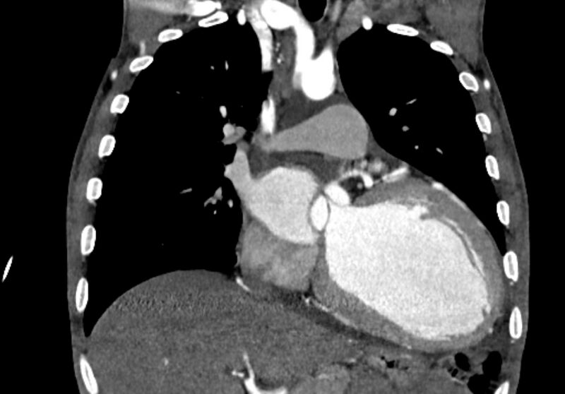 File:Coarctation of aorta with aortic valve stenosis (Radiopaedia 70463-80574 C 96).jpg