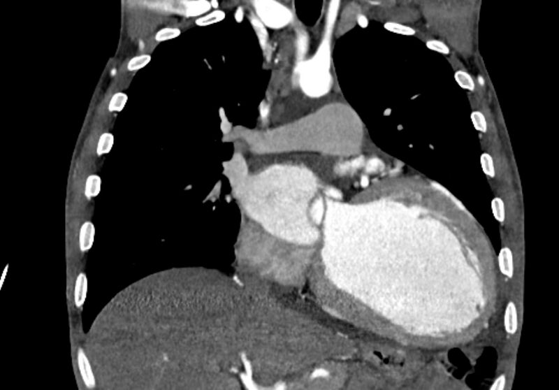 File:Coarctation of aorta with aortic valve stenosis (Radiopaedia 70463-80574 C 98).jpg