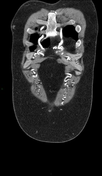 File:Coarctation of the aorta (Radiopaedia 74632-88521 B 4).jpg