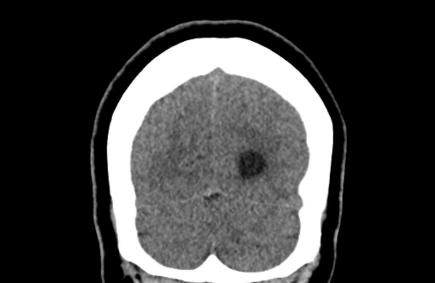 Colloid cyst (Radiopaedia 53180-59146 Coronal non-contrast 73).jpg