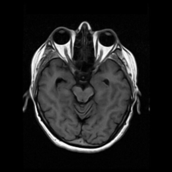 File:Colloid cyst with hydrocephalus (Radiopaedia 9373-10065 Axial T1 7).jpg