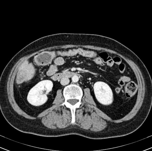 File:Colon carcinoma with hepatic metastases (Radiopaedia 29477-29961 A 54).jpg