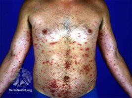 Disseminated secondary eczema