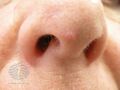 Fibrous papule of the nose (DermNet NZ lesions-fibrous-papule3).jpg