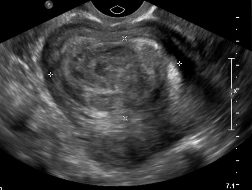 Figure 11.1B Transverse Ultrasound of the Uterus with a mass.jpg