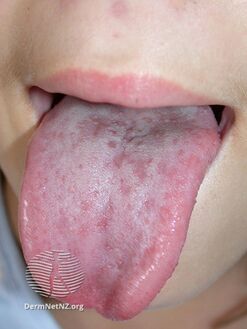 Spots on tongue