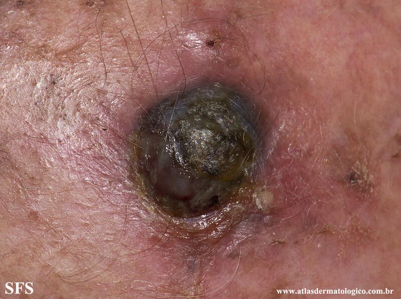 File:Melanoma (Dermatology Atlas 95).jpg