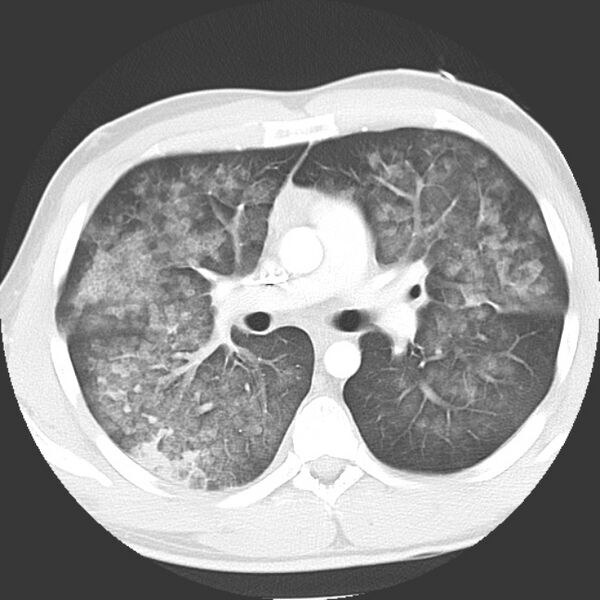 File:Near drowning pulmonary edema (Radiopaedia 16868-16591 Axial lung window 20).jpg