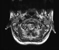 Neurofibromatosis type 1 (Radiopaedia 80355-93740 Axial T2 2).jpg