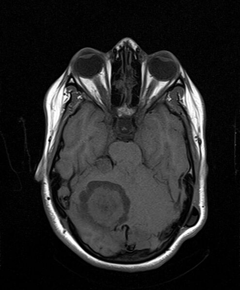 File:Neurofibromatosis type 2 (Radiopaedia 66211-75401 Axial T1 12).jpg