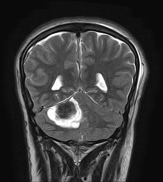 File:Neurofibromatosis type 2 (Radiopaedia 66211-75401 Coronal T2 18).jpg