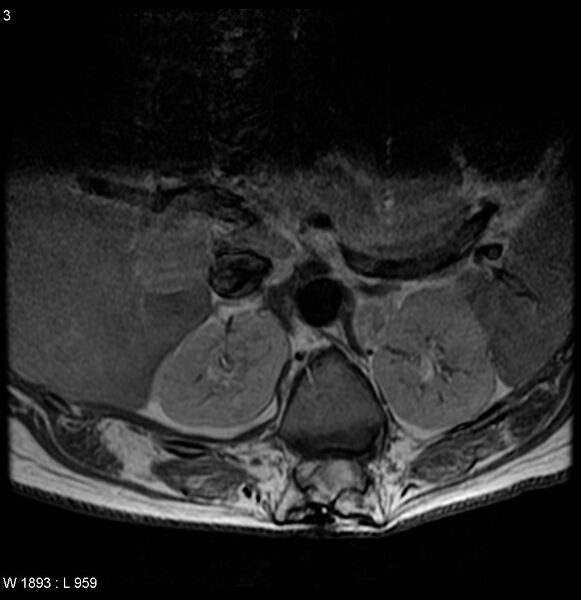File:Neurofibromatosis type 2 - cranial and spinal involvement (Radiopaedia 5351-7112 Axial T1 C+ 3).jpg