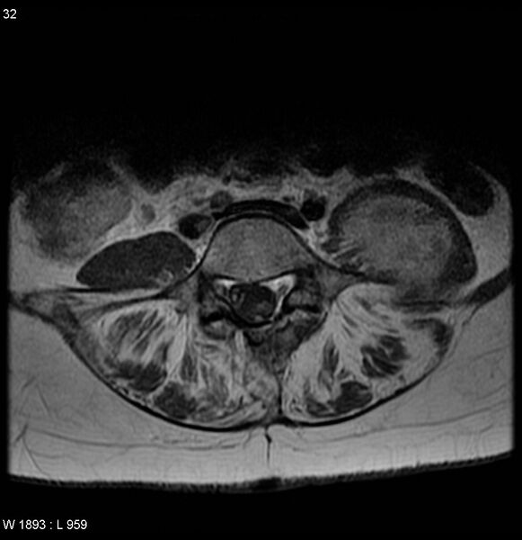 File:Neurofibromatosis type 2 - cranial and spinal involvement (Radiopaedia 5351-7112 Axial T1 C+ 32).jpg