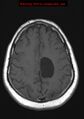 Neuroglial cyst (Radiopaedia 10713-11184 Axial T1 6).jpg