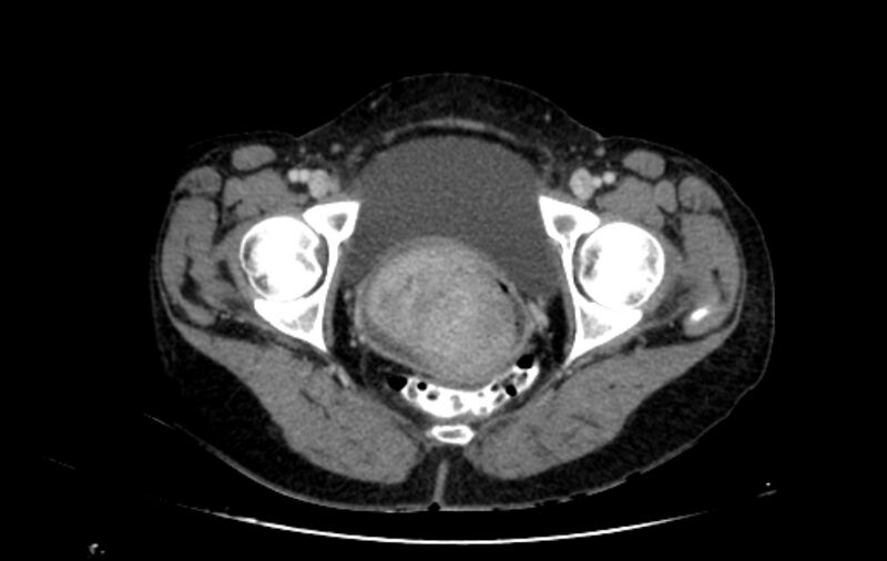 File:Non-puerperal uterine inversion (Radiopaedia 78343-91094 A 63).jpg