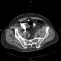 Non Hodgkin lymphoma in a patient with ankylosing spondylitis (Radiopaedia 84323-99624 Axial non-contrast 56).jpg