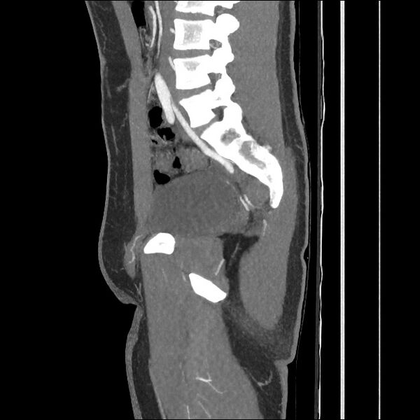 File:Normal CT angiogram of pelvis (Radiopaedia 45390-49430 C 30).jpg