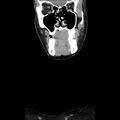 Normal CT of the neck (Radiopaedia 14575-14500 Coronal C+ 11).jpg