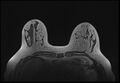 Normal breast MRI - dense breasts (Radiopaedia 80454-93850 Axial T1 71).jpg