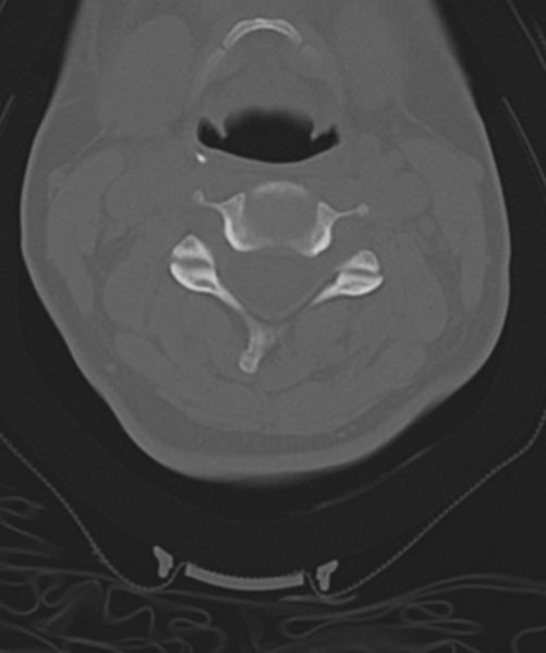 File:Normal cervical spine MRI (including Dixon) (Radiopaedia 42762-45926 Axial bone window 26).png