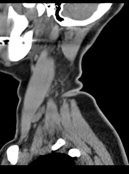 File:Normal cervical spine MRI (including Dixon) (Radiopaedia 42762-45926 C 3).png