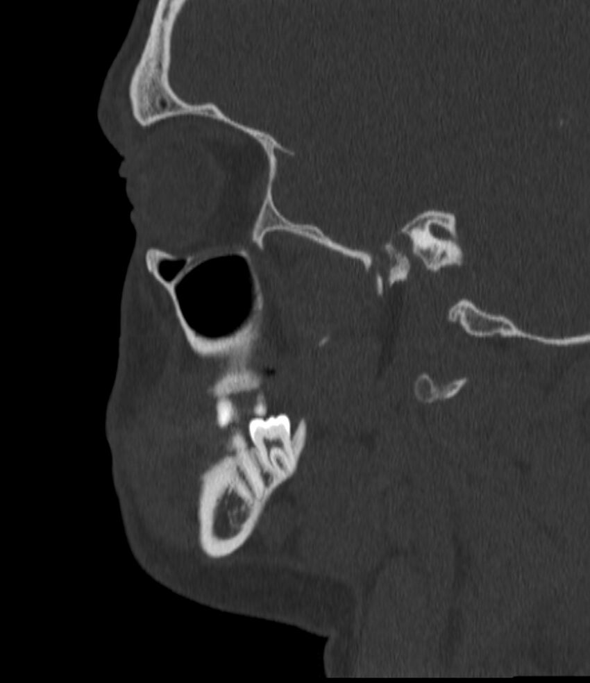 Normal facial bone CT (Radiopaedia 88742-105476 Sagittal bone window 56).jpg