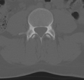 Normal lumbar spine CT (Radiopaedia 46533-50986 Axial bone window 45).png