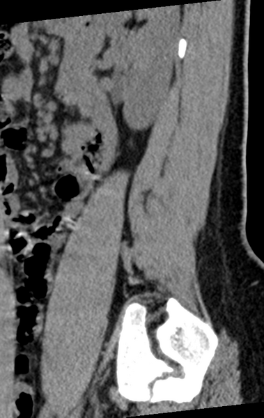 File:Normal lumbar spine CT (Radiopaedia 46533-50986 C 17).png