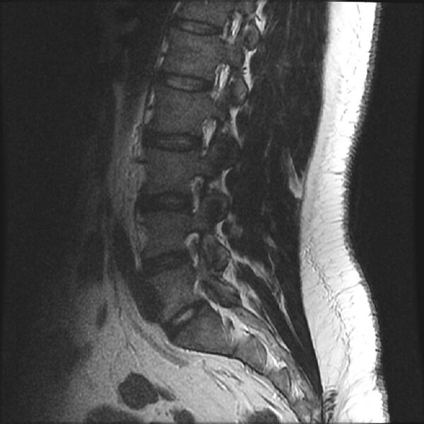 File:Normal lumbar spine MRI (Radiopaedia 43051-46311 Sagittal T2 7).jpg