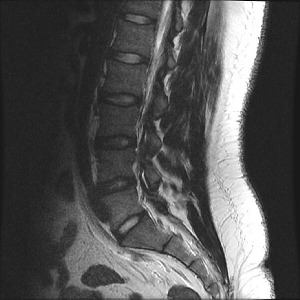 File:Normal lumbar spine MRI (Radiopaedia 43051-46311 Sagittal T2 8).jpg