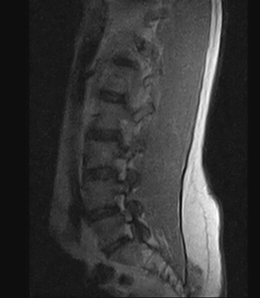 File:Normal lumbar spine MRI - low-field MRI scanner (Radiopaedia 40976-43699 Sagittal T1 3).jpg