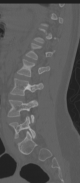 File:Normal lumbosacral CT (Radiopaedia 37923-39867 Sagittal bone window 36).png