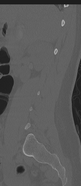 File:Normal lumbosacral CT (Radiopaedia 37923-39867 Sagittal bone window 75).png
