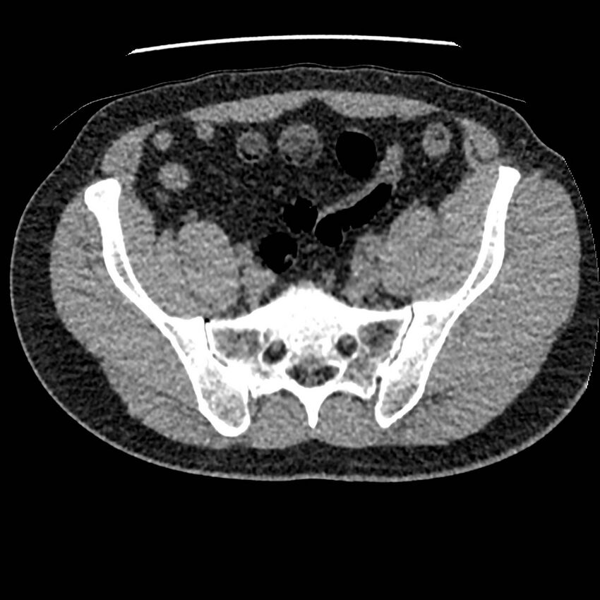 Obstructing ureteric calculus and ureteric anatomy (Radiopaedia 62730-71042 Axial non-contrast 121).jpg