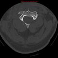 Occipital condyle fracture (Radiopaedia 18366-18208 Axial bone window 25).jpg