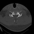 Occipital condyle fracture (Radiopaedia 31755-32691 Axial bone window 55).jpg