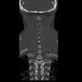 Occipital condyle fracture (Radiopaedia 31755-32691 Coronal bone window 29).jpg