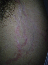 Steroid-induced striae
