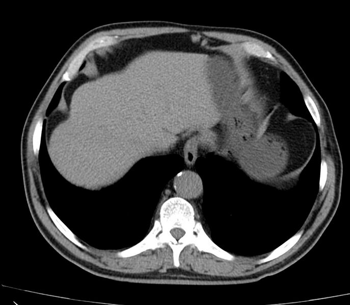File:Abdominal aortic aneurysm (Radiopaedia 22421-22458 non-contrast 6).jpg
