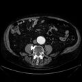 Abdominal aortic aneurysm (Radiopaedia 25855-26001 Axial C+ arterial phase 80).jpg