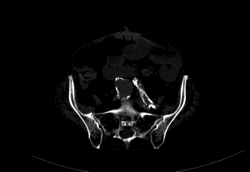 File:Abdominal aortic aneurysm - impending rupture (Radiopaedia 19233-19246 B 42).jpg