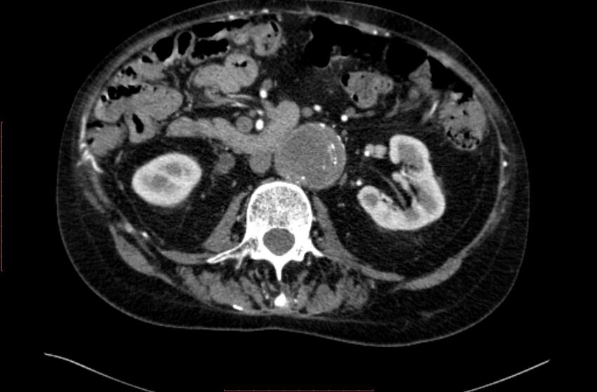Abdominal aortic interposition tube graft and aneurysm thrombosis (Radiopaedia 71438-81857 Axial C+ arterial phase 70).jpg