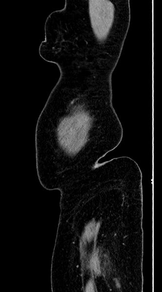 File:Abdominal hydatid disease (Radiopaedia 68223-77737 Sagittal C+ portal venous phase 72).jpg