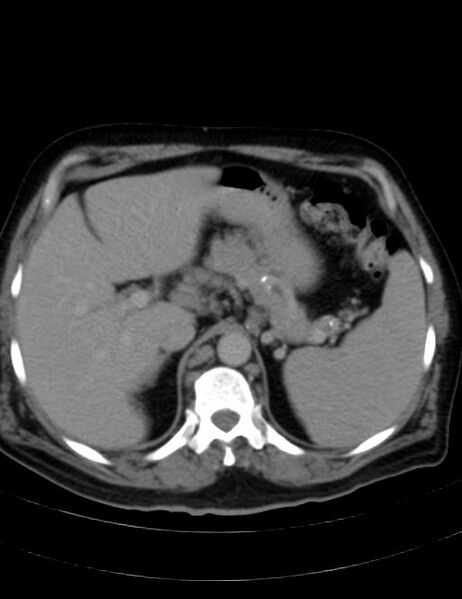 File:Abdominal lymphoma - with sandwich sign (Radiopaedia 53486-59492 Axial C+ portal venous phase 12).jpg